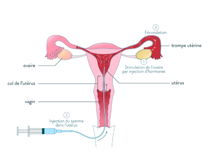 L’insémination artificielle intra-utérine avec sperme du conjoint (IAC) consiste à injecter des spermatozoïdes « préparés » dans la cavité utérine, le jour de l’ovulation. La stimulation des ovaires va permettre de maîtriser et d’améliorer l’ovulation.